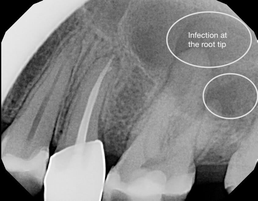 The Top 5 Reasons Why you Need Dental XRays