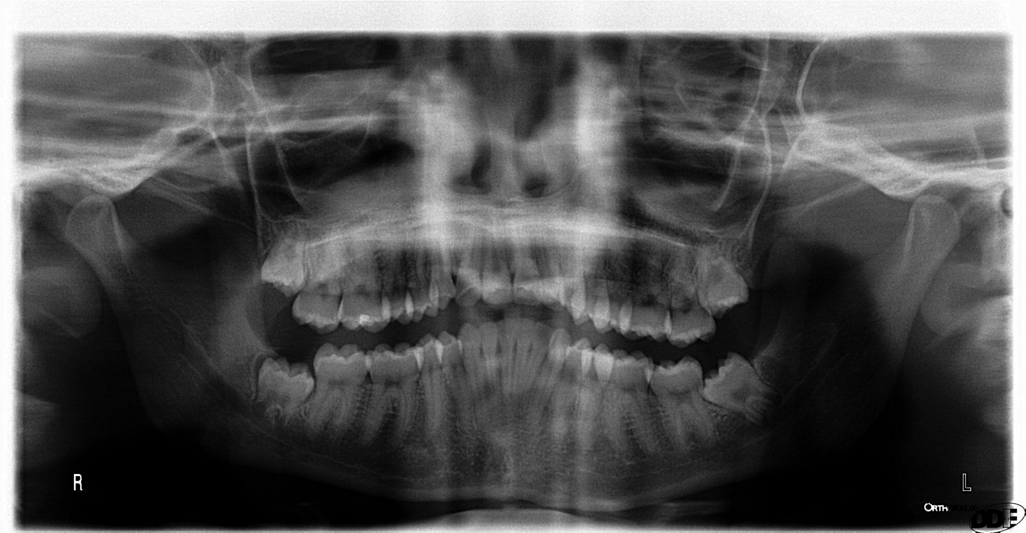 The Top 5 Reasons Why you Need Dental X-Rays