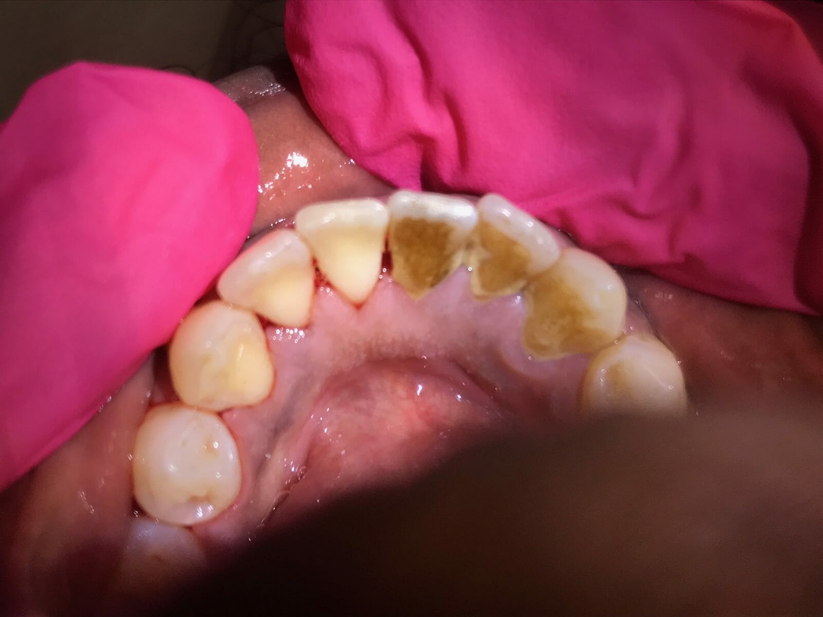 I Need a Deep Cleaning?!?! What is That? Monfredi Family Dental