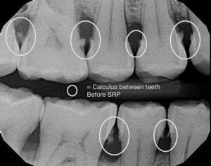 image of calculus on teeth
