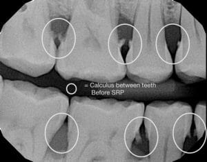 Deep cleaning at dentist - YouTube