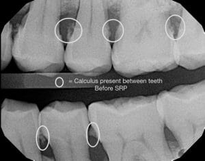 calculus between teeth before SRP