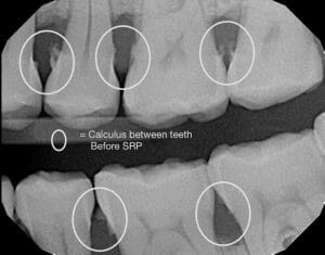 Calculus between teeth